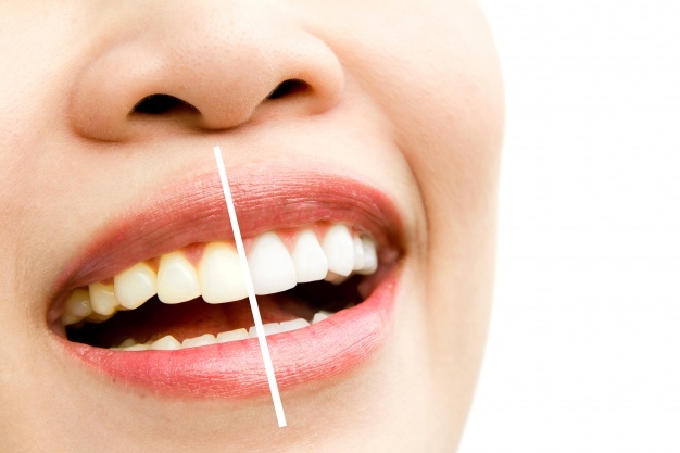 وصفة مجربة لتبيض الأسنان من أول إستعمال